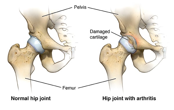 hip-replacement-surgery