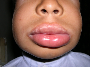 ลักษณะของริมฝีปากบวม (Angioedema)